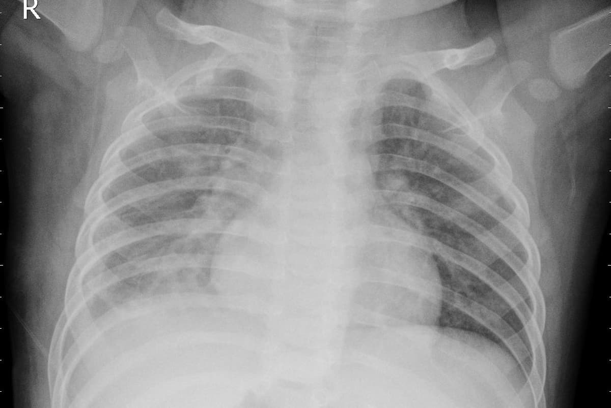 Pneumonia — NIH Chest X-ray14