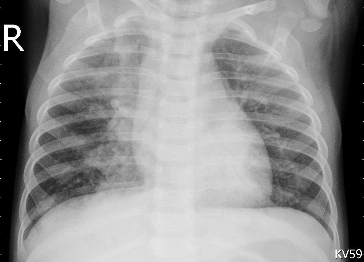 Pneumonia — NIH Chest X-ray14