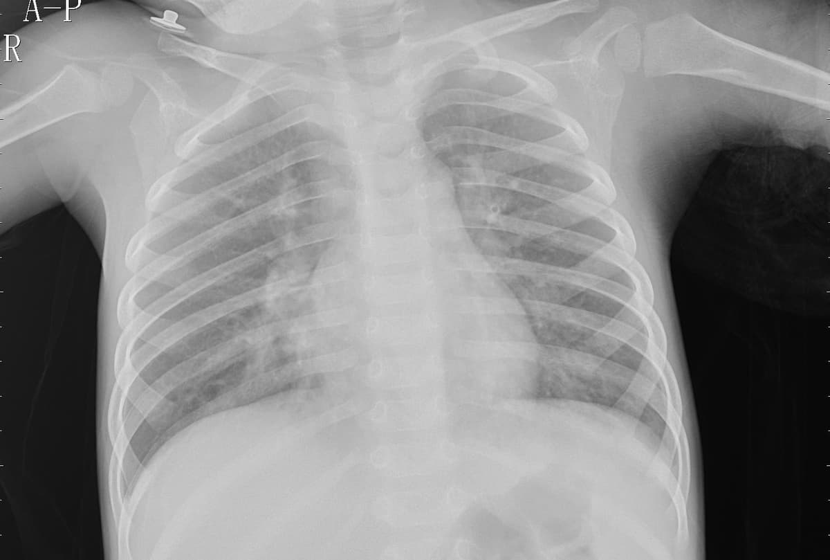 Pneumonia — NIH Chest X-ray14