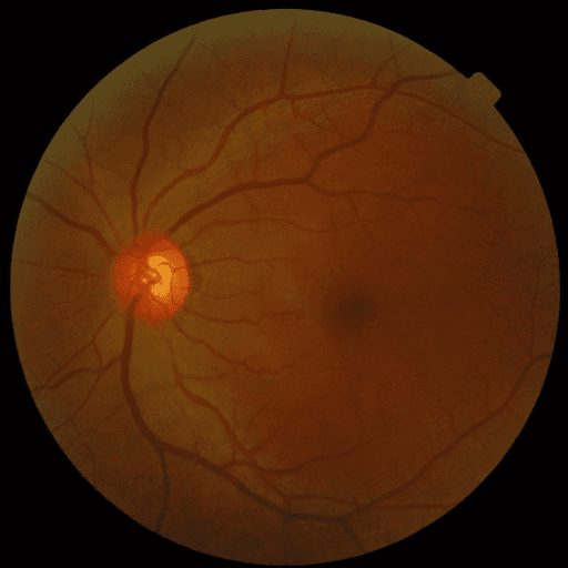 No Diabetic Retinopathy — MESSIDOR-2
