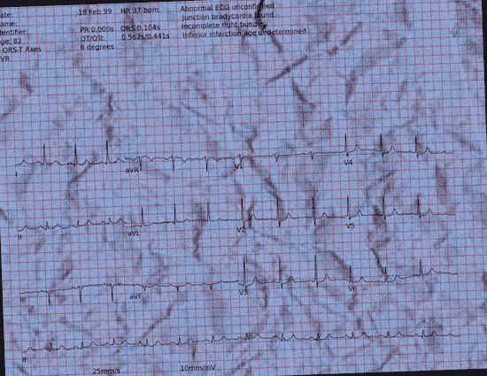 Normal ECG — PTB-XL