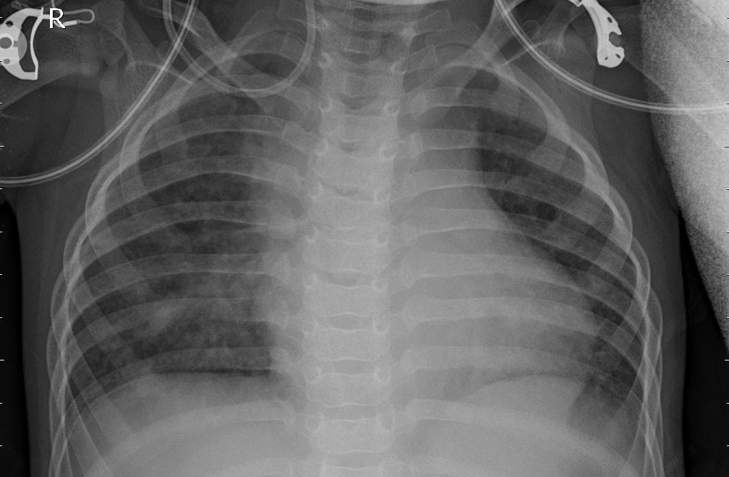 Pneumonia — NIH Chest X-ray14