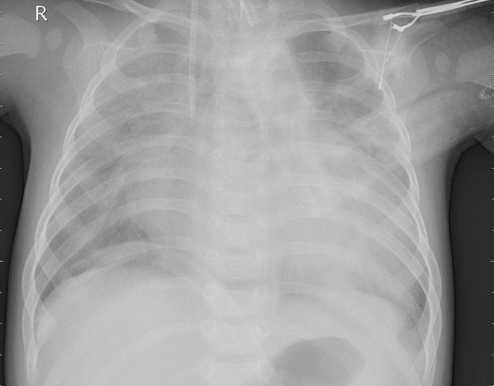 Pneumonia — NIH Chest X-ray14