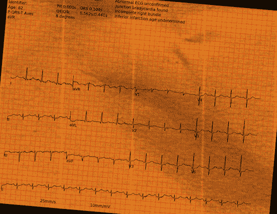 Normal ECG — PTB-XL