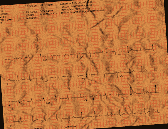 Normal ECG — PTB-XL