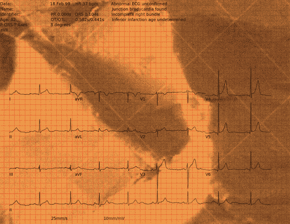 Normal ECG — PTB-XL