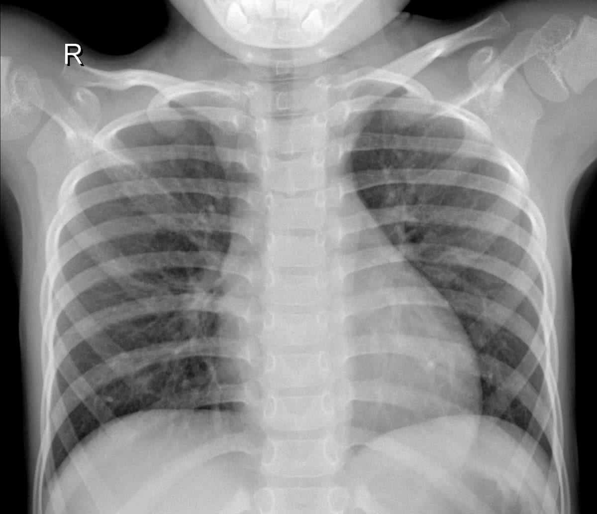 Radiografia Normal — NIH Chest X-ray14