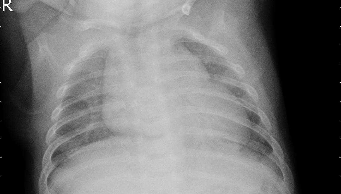 Pneumonia — NIH Chest X-ray14