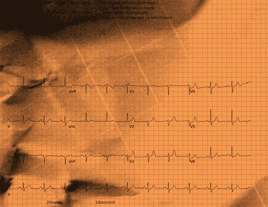 Normal ECG — PTB-XL