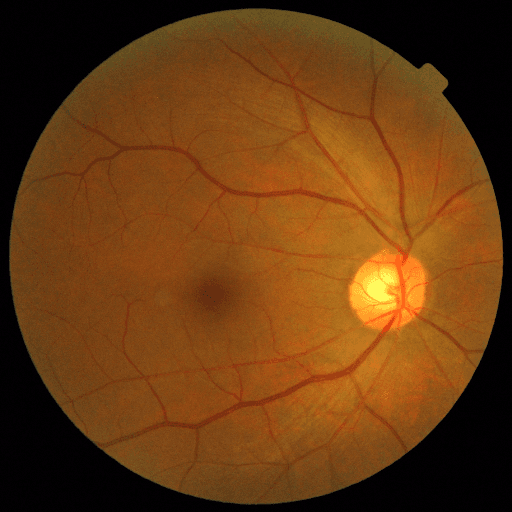 Proliferative DR — MESSIDOR-2