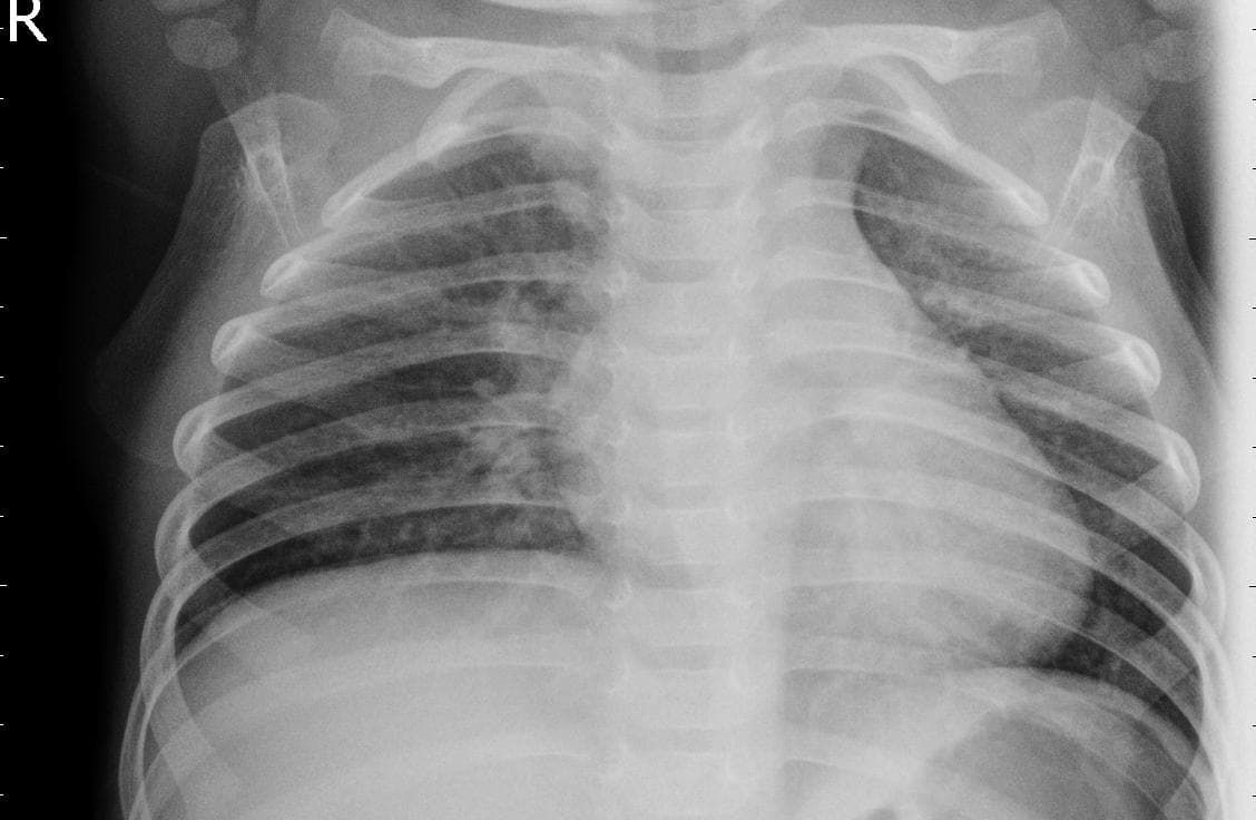 Pneumonia — NIH Chest X-ray14