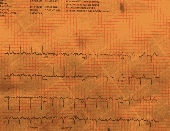 Normal ECG — PTB-XL