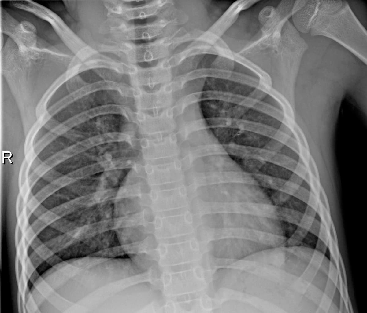 Radiografia Normal — NIH Chest X-ray14