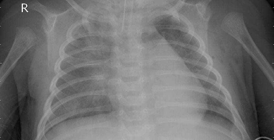 Pneumonia — NIH Chest X-ray14