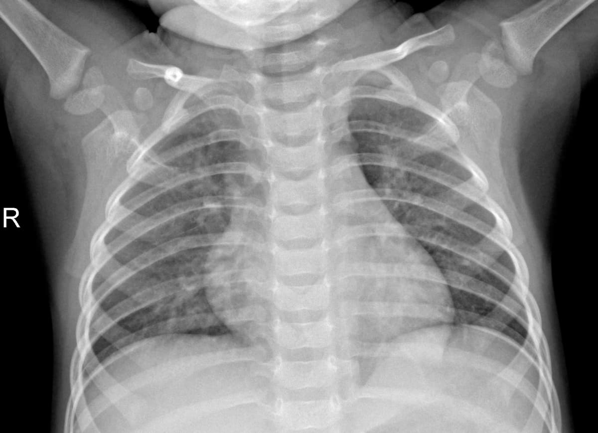 Radiografia Normal — NIH Chest X-ray14