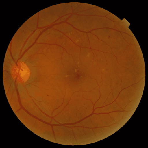 No Diabetic Retinopathy — MESSIDOR-2