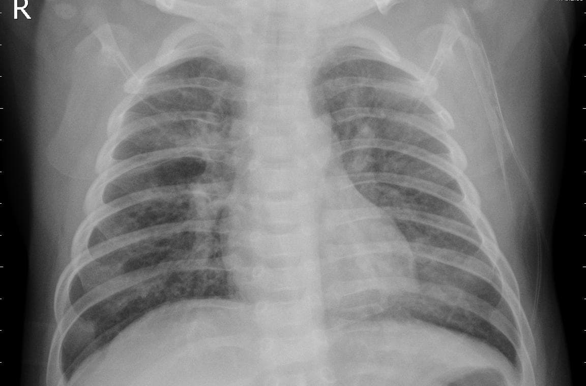 Pneumonia — NIH Chest X-ray14
