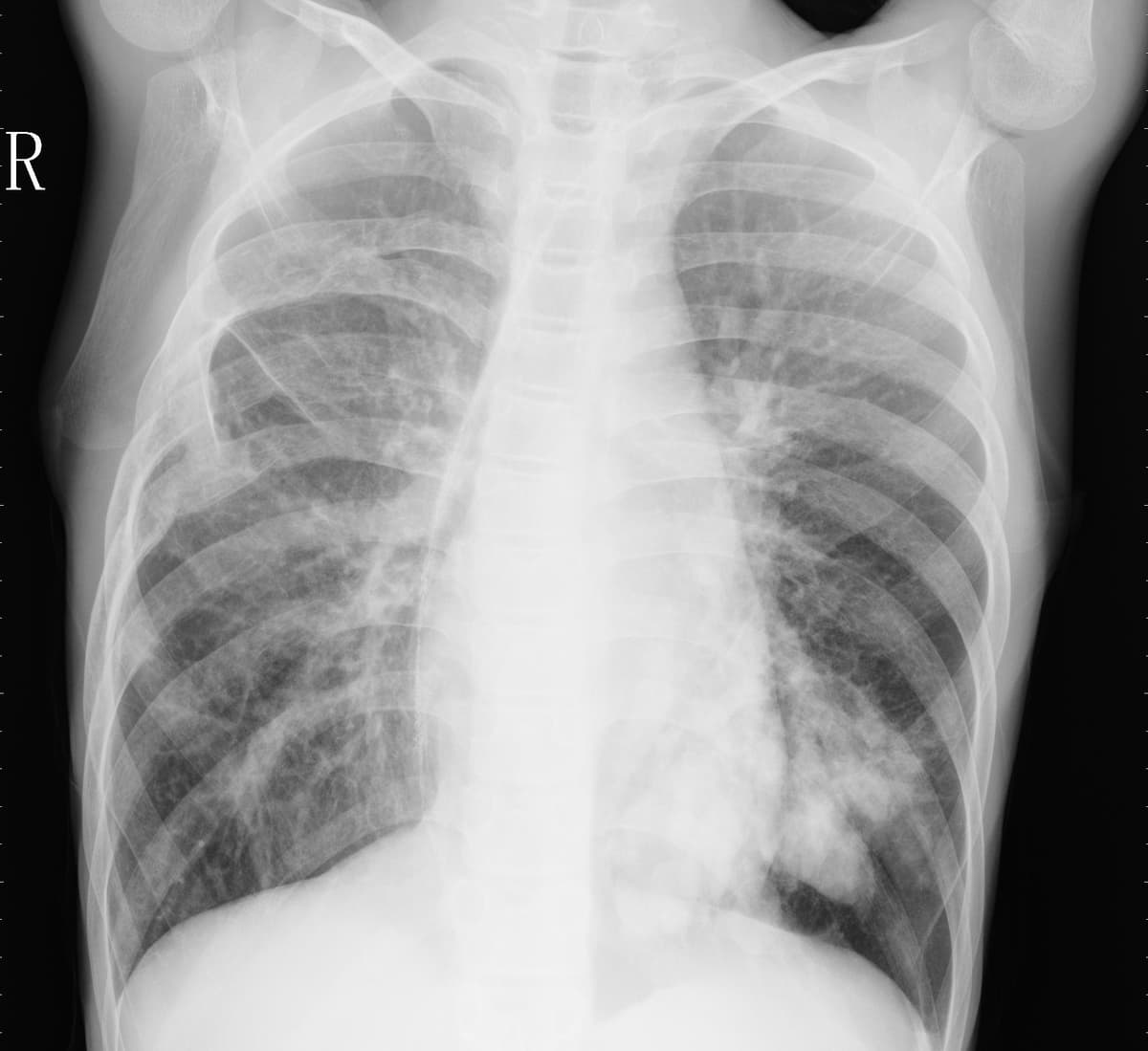 Pneumonia — NIH Chest X-ray14
