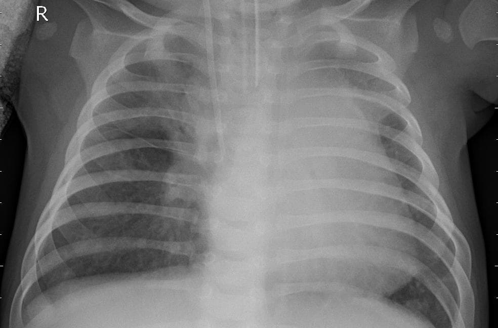Pneumonia — NIH Chest X-ray14