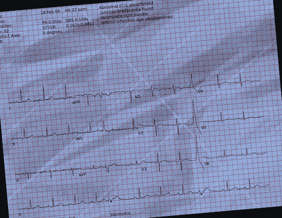 Normal ECG — PTB-XL