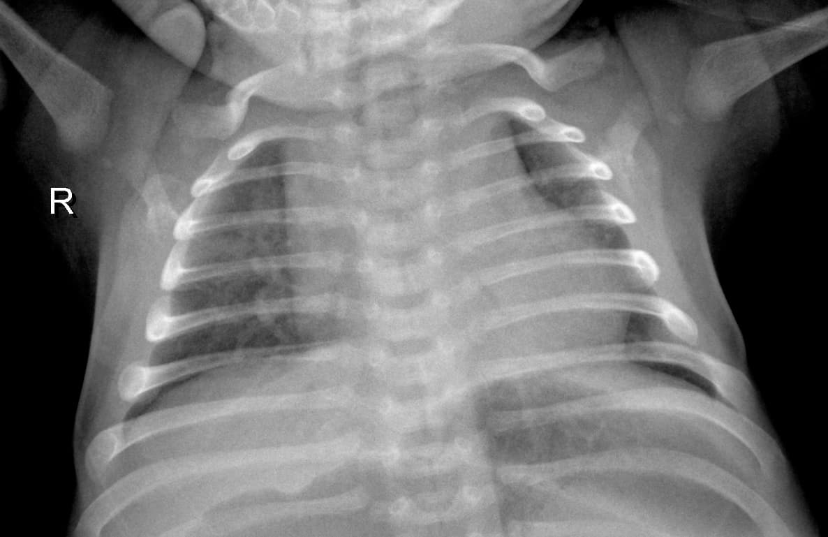Radiografia Normal — NIH Chest X-ray14