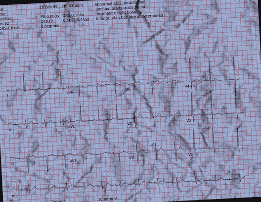 Normal ECG — PTB-XL