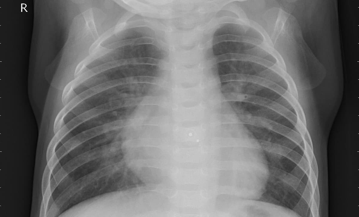 Pneumonia — NIH Chest X-ray14