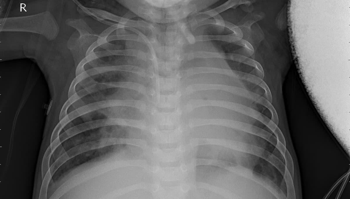 Pneumonia — NIH Chest X-ray14