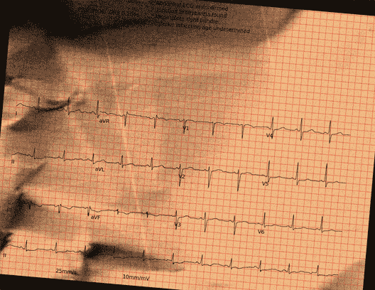 Normal ECG — PTB-XL