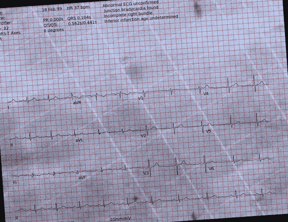 Normal ECG — PTB-XL