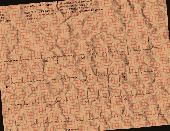 Normal ECG — PTB-XL