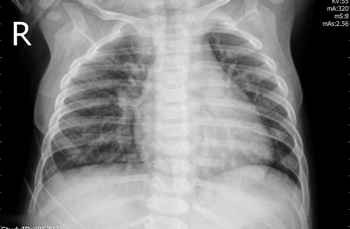 Pneumonia — NIH Chest X-ray14