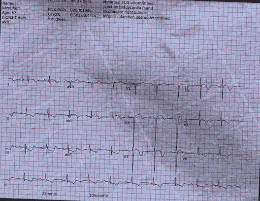 Normal ECG — PTB-XL