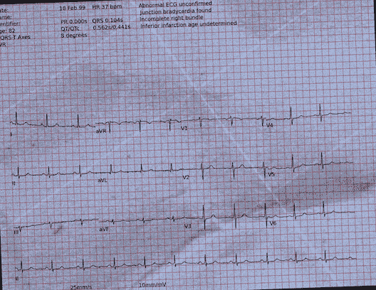 Normal ECG — PTB-XL
