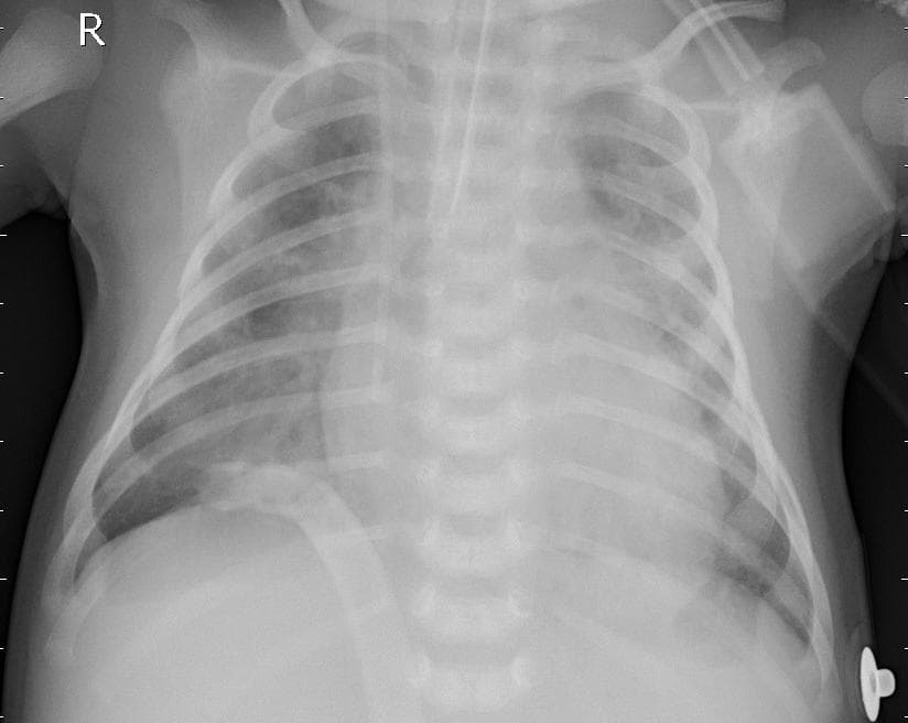Pneumonia — NIH Chest X-ray14