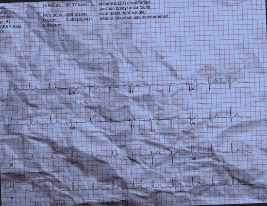 Normal ECG — PTB-XL