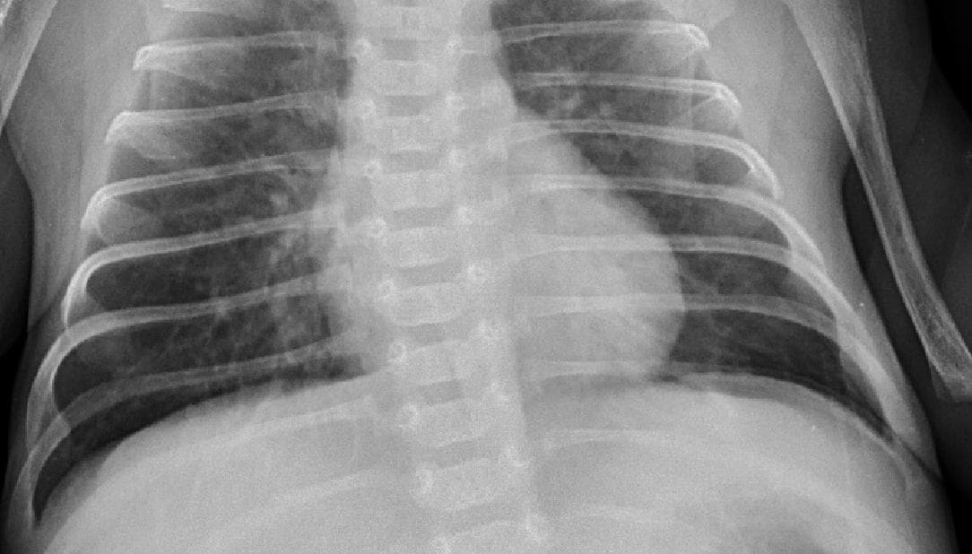 Pneumonia — NIH Chest X-ray14