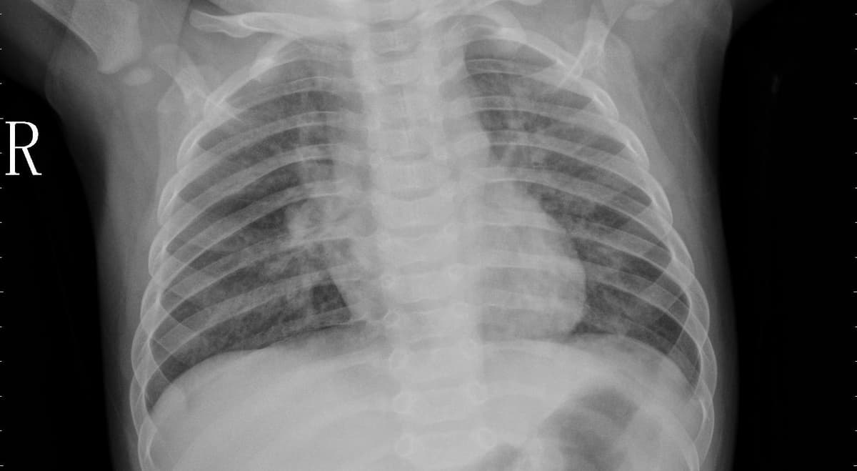 Pneumonia — NIH Chest X-ray14