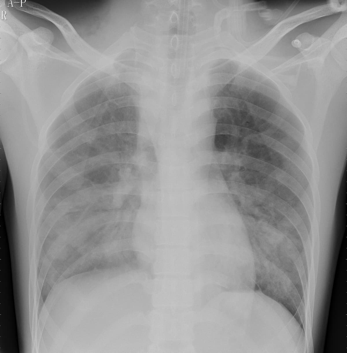 Pneumonia — NIH Chest X-ray14