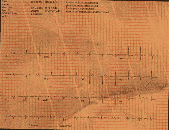 Normal ECG — PTB-XL