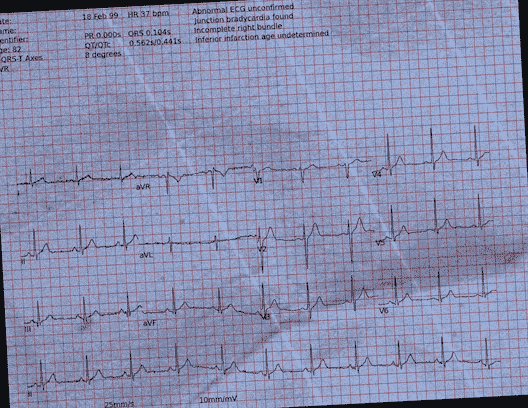 Normal ECG — PTB-XL
