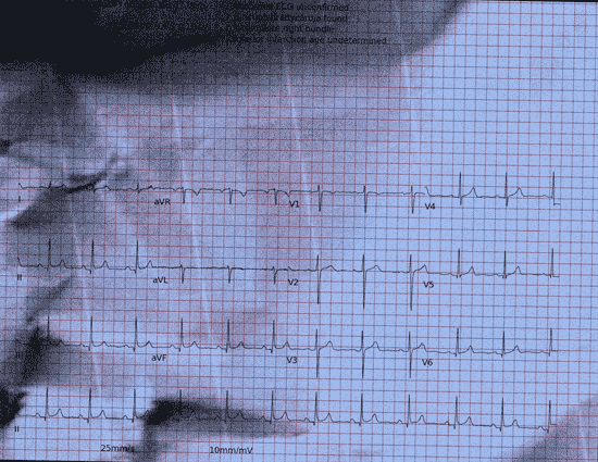 Normal ECG — PTB-XL