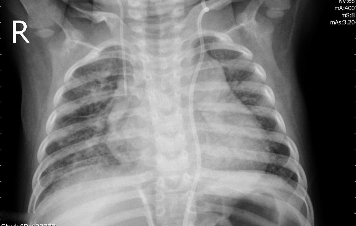 Pneumonia — NIH Chest X-ray14