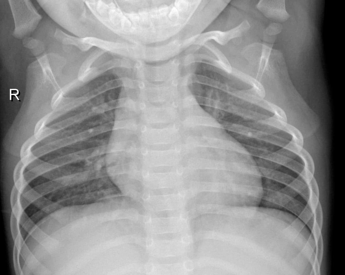 Radiografia Normal — NIH Chest X-ray14