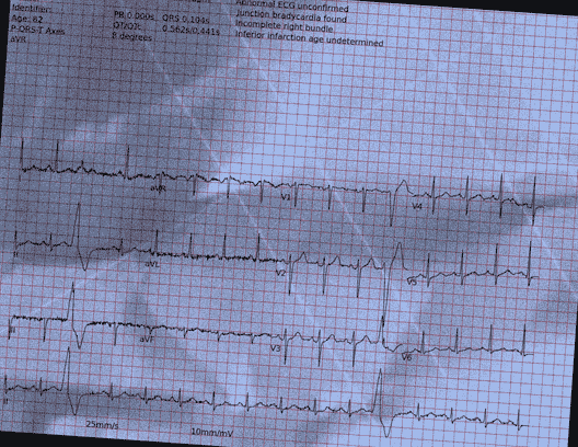 Normal ECG — PTB-XL