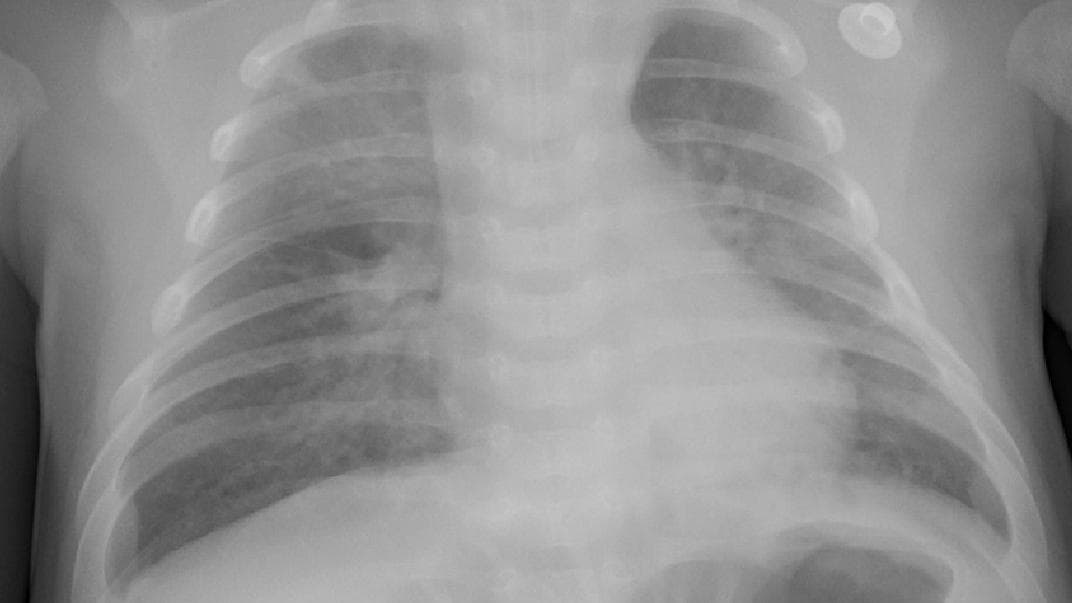 Pneumonia — NIH Chest X-ray14