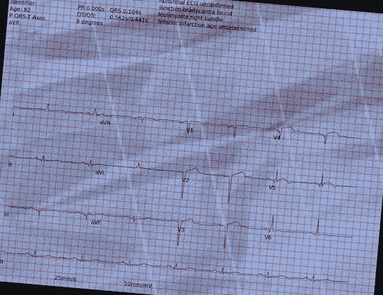 Normal ECG — PTB-XL