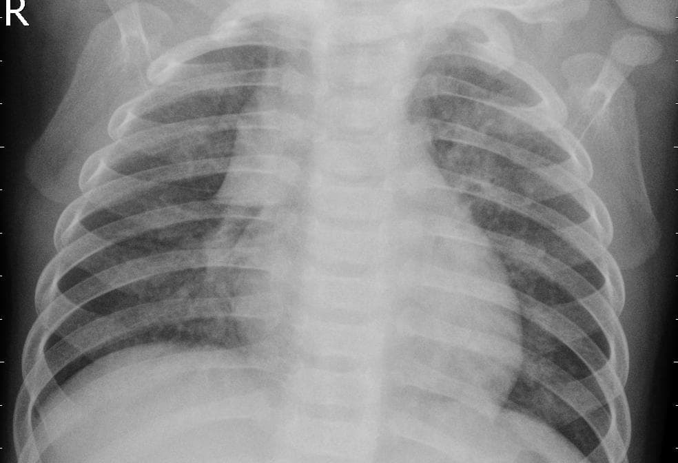 Pneumonia — NIH Chest X-ray14