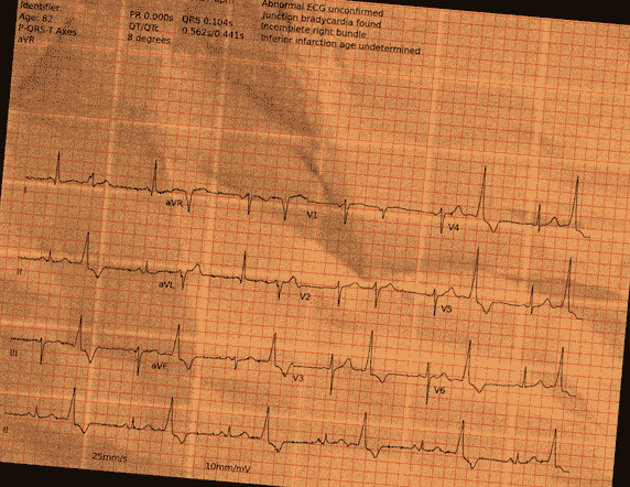 Normal ECG — PTB-XL