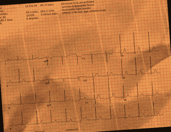 Normal ECG — PTB-XL